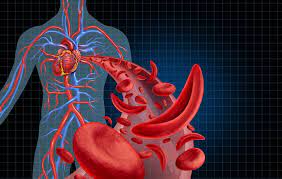 تصویر سه بعدی از آناتومی شریان انسان، نشان دهنده گلبول های قرمز طبیعی و سلول های خونی داسی شکل از قلب دور می شود